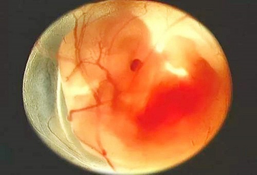 得到6个囊胚，试管婴儿过筛的几率是多少？